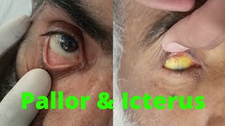 PALLOR and ICTERUS in EYE  ANEMIA and JAUNDICE in eye examination [upl. by Norwood]