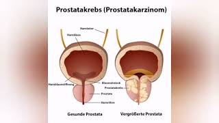 Prostatakrebs Ursachen Diagnose und Therapie [upl. by Anjali501]