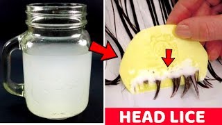 How to get rid of lice eggs in hair permanently in one day naturally with vinegar [upl. by Hallimaj371]