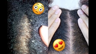 How I Cured My EXTREMELY Dry Scalp [upl. by Ricardo]