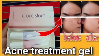 Benzoyl Peroxide Clindamycin Phosphate Gel Uses Benefits How to use  Cureskin Acne Duo [upl. by Yasu319]