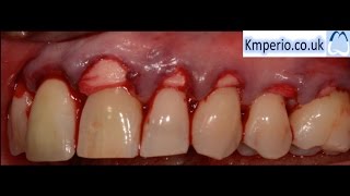 Alloderm Periodontal Surgery for Gum RecessionGraftingRoot CoverageUpper Teeth [upl. by Maxey]