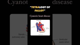 Tetralogy of fallot pediatrics heart child cyanosis blue baby mother kids medicine [upl. by Eirrej]