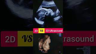 2D VS 3D Ultrasound in pregnancy pregnant ultrasound shortsfeed [upl. by Donnenfeld]