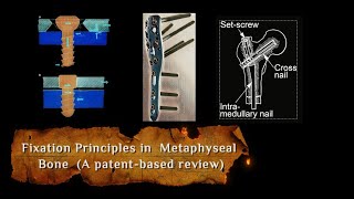 Metaphyseal Bone Fixation Principles What Everyone Needs to Know [upl. by Nnyrb]