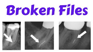 Endodontic Instrument fracture  Separated File Management of Broken Files Bypass Technique [upl. by Kussell]