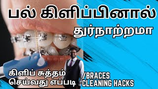 பல் கிளிப் அணிந்தவர்கள் கண்டிப்பாக செய்ய வேண்டியவை𝐇𝐨𝐰 𝐭𝐨 𝐜𝐥𝐞𝐚𝐧 𝐛𝐫𝐚𝐜𝐞𝐬 𝐢𝐧 𝐭𝐚𝐦𝐢𝐥 [upl. by Schaffer]