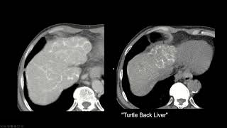 Interpreting CT Abdo Cirrhosis Portal Hypertension Schistosomiasis [upl. by Pacorro]