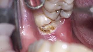 operculectomy of mn 3dr molar [upl. by Nagiem]