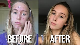 FROM SPOT TO HOT My Acne Story [upl. by Nine]