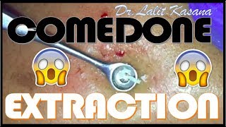 COMEDONE EXTRACTION  ANTI ACNE THERAPY BLACKHEAD REMOVAL [upl. by Carmita]