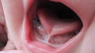 Tongue tie  Ankyloglossia 👅 [upl. by Keenan]