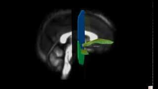 Delineation of the Uncinate Fasciculus [upl. by Viking]