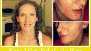 How I Got Rid of My Acne  OCM Mistakes Tips Skincare Routine  Photos  VitaLivesFree [upl. by Brenk]