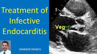 Treatment of Infective Endocarditis [upl. by Belier]