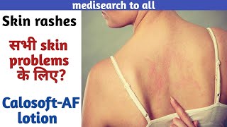 CalosoftAF lotionUsesसभी skin problems के लिएCommon skin rashes How to apply in hindi [upl. by Aneri33]