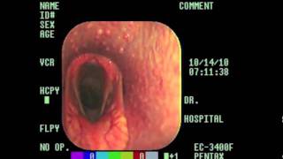 Laryngeal Hemiplegia Explained m4v [upl. by Ennasil]