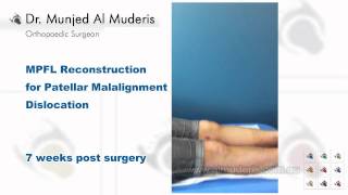 MPFL Reconstruction for Patellar Malalignment Dislocation  7 weeks post surgery [upl. by Clareta]