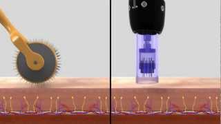 DERMAPEN SISTEMA DE REMODELACIÓN TISULAR [upl. by Jahdal]