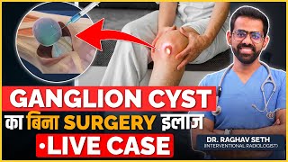 Live Ganglion Cyst Removal Case Without Surgery  Non Surgical Treatment of Ganglion Cyst [upl. by Syman]