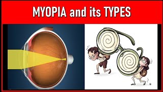 Unveiling the Secrets of Myopia Exploring Various Types and Causes [upl. by Aromat]