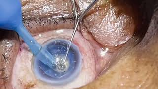 Phaco Direct Chop  unedited video in a Hyper Mature Cataract with Elastic Posterior plaque [upl. by Wynnie]