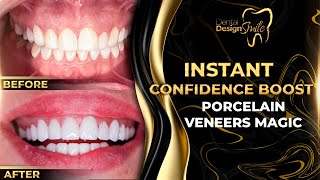 Instant Confidence Boost Porcelain Veneers Magic [upl. by Eynenihc]