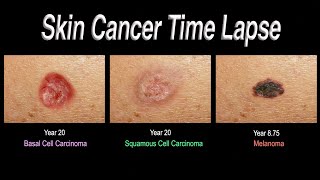 Skin Cancer Time Lapse Basal Cell Carcinoma Squamous Cell Carcinoma Melanoma [upl. by Ahsyla]