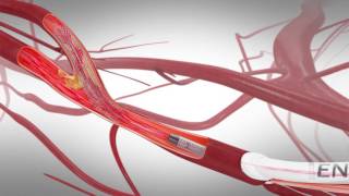 TCAR Transcarotid Arterial Revascularization [upl. by Bernie70]