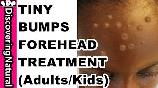 HOW TO GET RID OF TINY BUMPS ON FOREHEAD in 10 DAYS  Acne Pimple Rashes I KIDS and ADULTS [upl. by Boyden]