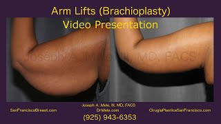 Brachioplasty SF Bay Area Arm Lifts and Arm Skin Tightening  10 [upl. by Schenck]