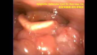 epiglottic vallecular cyst 會厭溝會厭溪囊腫 劉耿僚醫師 [upl. by Naara367]