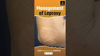 Management of Leprosy  Treatment Prevention Leprosy management treatment shortvideo nursing [upl. by Phillips]