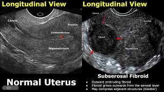 Uterus Ultrasound Normal Vs Subserosal Fibroid Images  Uterine Leiomyomas Cases  Pelvic USG Cases [upl. by Maurer365]