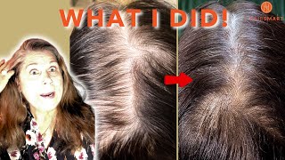 How I Reversed Extreme Hair Thinning [upl. by Nivra130]