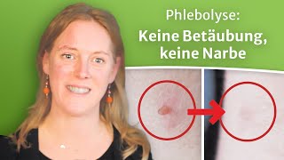 Stielwarze entfernen durch sanfte Verödung mit Phlebolyse ein Erfahrungsbericht gesundheit [upl. by Grote]