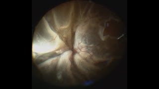 Funnel Retinal Detachment and Cataract with Posterior Synechiae [upl. by Rayna]