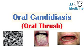 Oral Candidiasis Oral Thrush  Causes Pathophysiology Signs amp Symptoms Diagnosis Treatment [upl. by Ayanad]