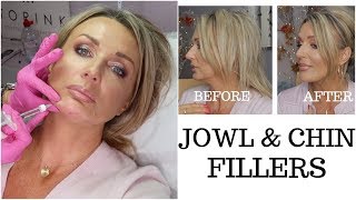 Jowls and Chin Fillers with Before And After Photos  my experience [upl. by Hcire]