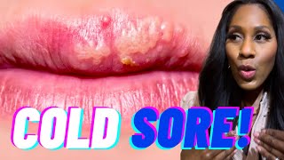 GET RID OF COLD SORES FAST Plus Are Cold Sores CONTAGIOUS What Causes Cold Sores A Doc Explains [upl. by Art]