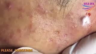 extractionblackheads blackhead ExtractionBlackheads On Face So Easy 17  BlackheadsRemoval [upl. by Ahseyt]