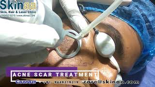 Acne Scar Laser Removal Treatment in Jaipur with Fractional Co2 FDA Approved Laser Skinaa Clinic [upl. by Nodnart579]