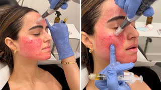 Getting the Vampire Facial 💉 You gotta see these results [upl. by Anohsal]