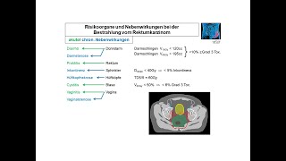 Risikoorgane und Nebenwirkungen beim Rektumkarzinom  Strahlentherapie Prof Hilke Vorwerk [upl. by Cleaves]