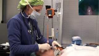 Video laryngoscope Tracheal intubation with Bougie Port [upl. by Adnerad]