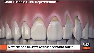 Receding Gums Can Now Be Corrected Without Gum Grafting Surgery [upl. by Dalenna]