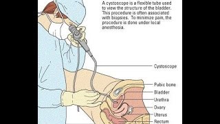 Video Cystoscopy Actual Procedure ENG SUB [upl. by Di]