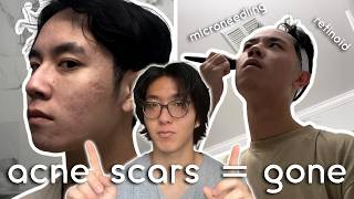 How I Helped my Friend Clear up His Acne Scars [upl. by Galatia]