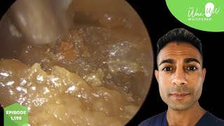 1198  Blocked Ear Wax Removal with Benign Osteoma [upl. by Lenore844]