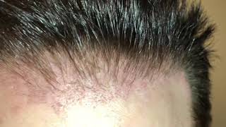 Three month FUE  Hasson and Wong Repair [upl. by Kaine]